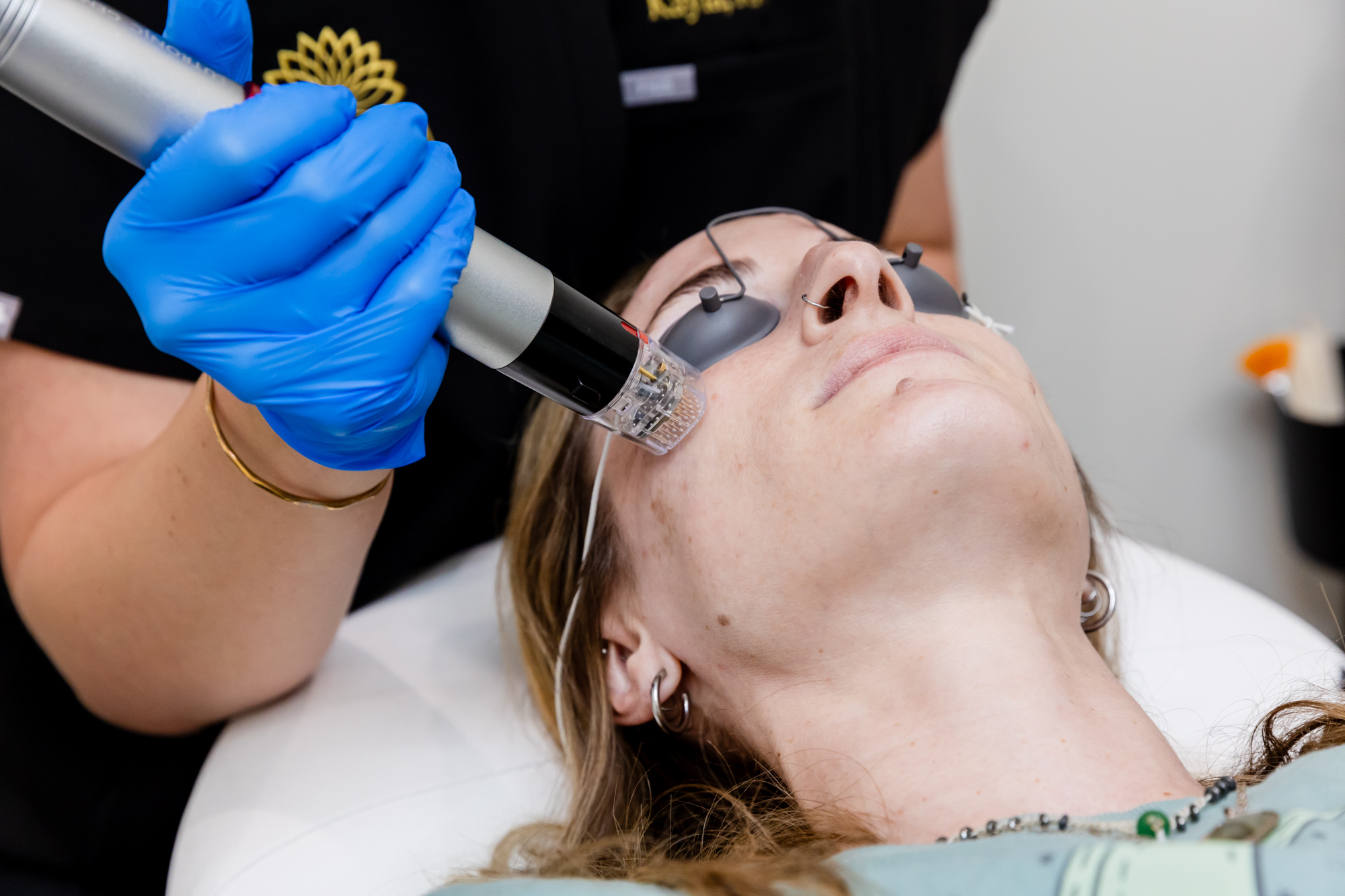 RF Microneedling in Winchester | Blossom Medical